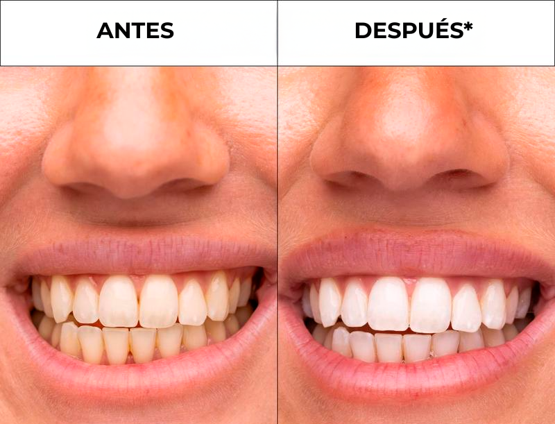 Cavari™ V34 Bandas Blanqueadoras – Blanqueamiento de Color Dental